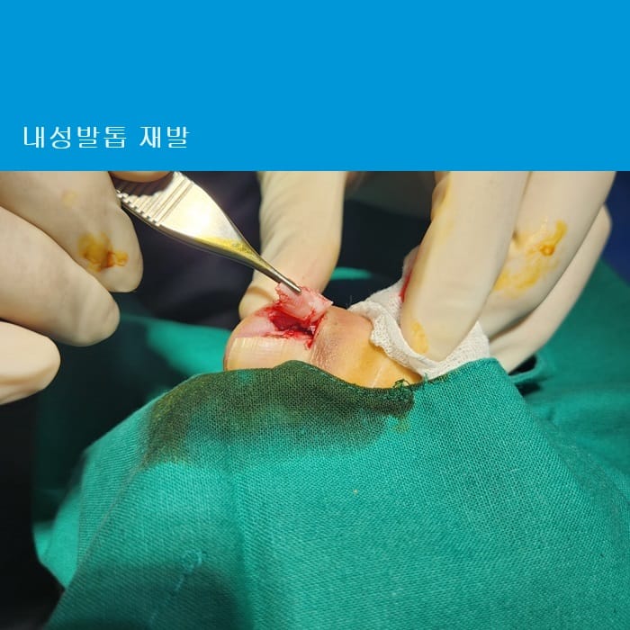 Ingrown Toenail Treatment & Surgery | Gangnam Standard Orthopedic Clinic Near Gangnam Station — 3