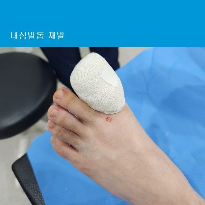 Ingrown Toenail Treatment & Surgery | Gangnam Standard Orthopedic Clinic Near Gangnam Station — 4
