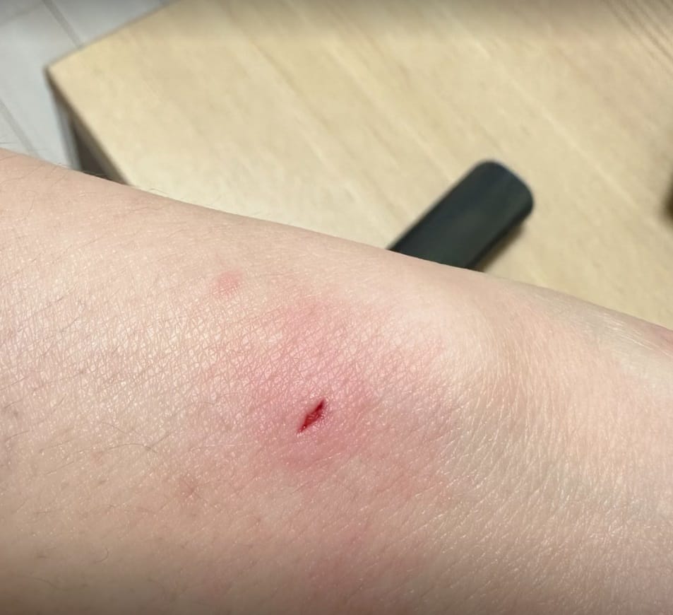 Cat Bite or Scratch? 3 Things You Must Do — Gangnam Standard Orthopedic Clinic — 2
