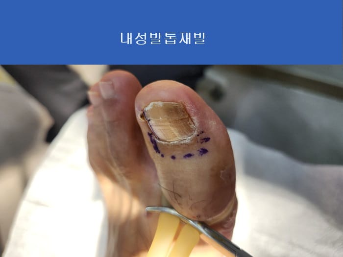 Ingrown Toenail Treatment & Recurrence Specialist | Gangnam Standard Orthopedic Clinic near Gangnam Station