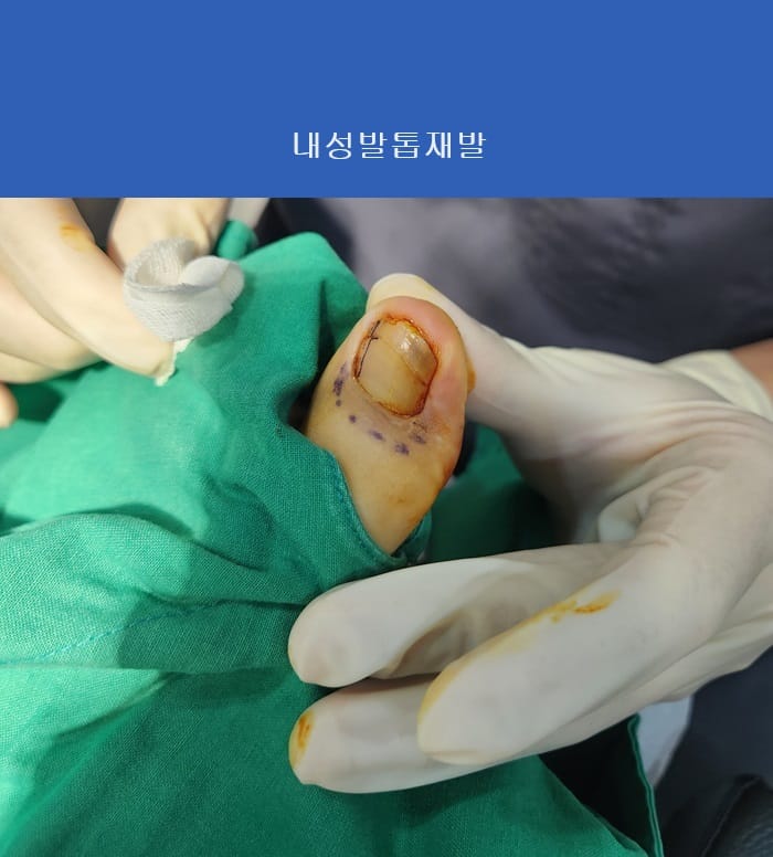 Ingrown Toenail Treatment & Recurrence Specialist | Gangnam Standard Orthopedic Clinic near Gangnam Station — 2
