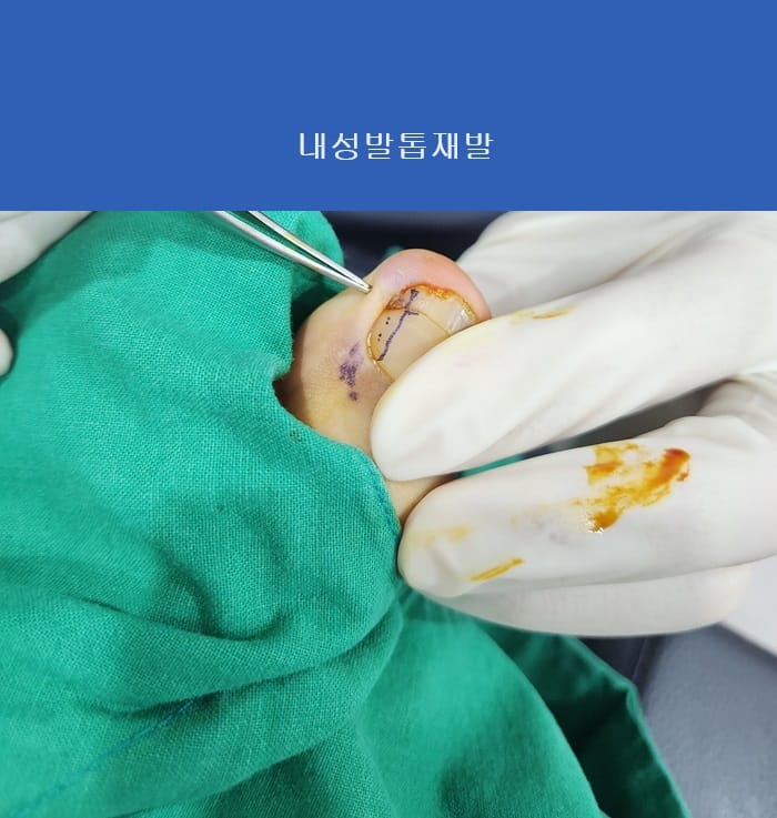 Ingrown Toenail Treatment & Recurrence Specialist | Gangnam Standard Orthopedic Clinic near Gangnam Station — 3