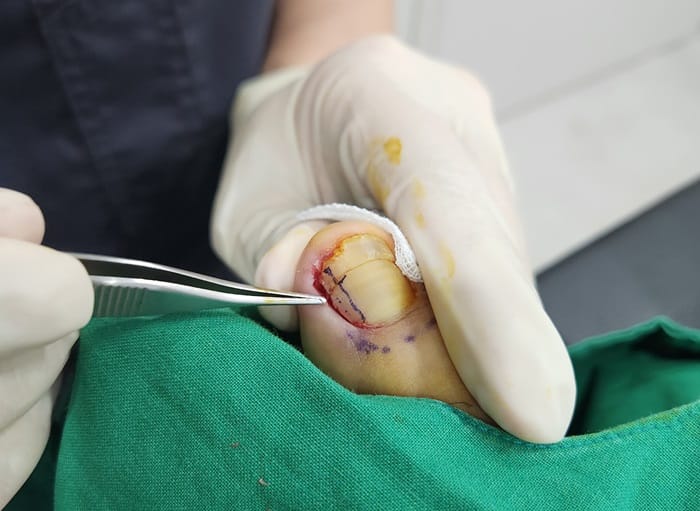 Ingrown Toenail Treatment & Recurrence Specialist | Gangnam Standard Orthopedic Clinic near Gangnam Station — 4