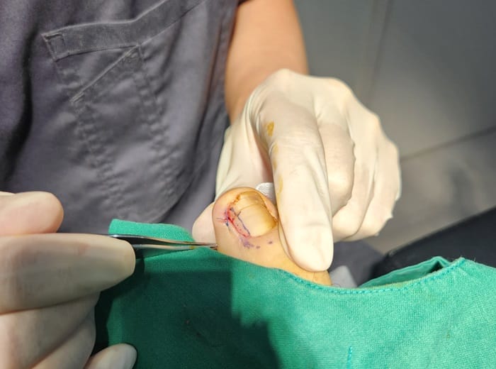 Ingrown Toenail Treatment & Recurrence Specialist | Gangnam Standard Orthopedic Clinic near Gangnam Station — 5