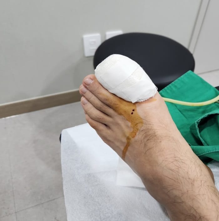 Ingrown Toenail Treatment & Recurrence Specialist | Gangnam Standard Orthopedic Clinic near Gangnam Station — 6
