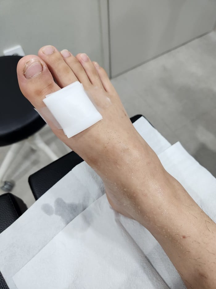 Ingrown Toenail Infection & Surgery | Gangnam Standard Orthopedic Clinic