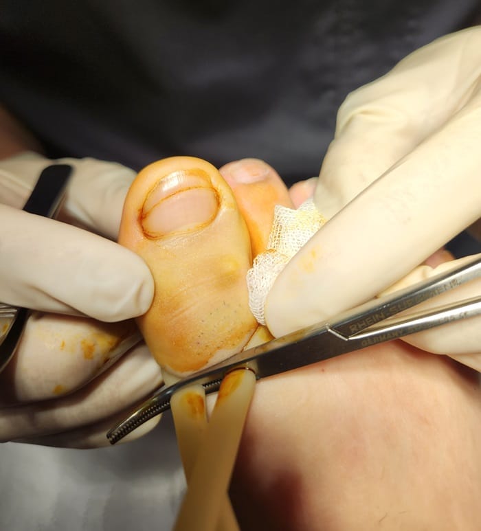 Ingrown Toenail Infection & Surgery | Gangnam Standard Orthopedic Clinic — 2