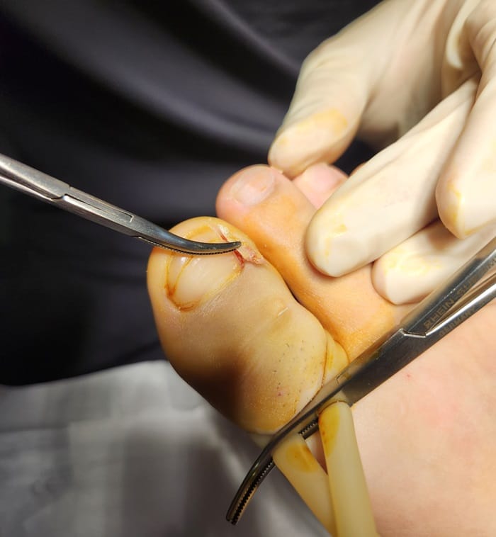 Ingrown Toenail Infection & Surgery | Gangnam Standard Orthopedic Clinic — 3