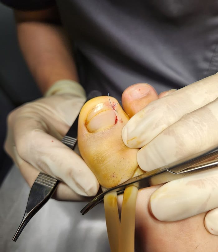 Ingrown Toenail Infection & Surgery | Gangnam Standard Orthopedic Clinic — 4