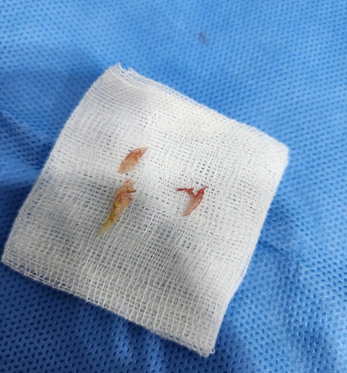 Ingrown Toenail Infection & Surgery | Gangnam Standard Orthopedic Clinic — 5