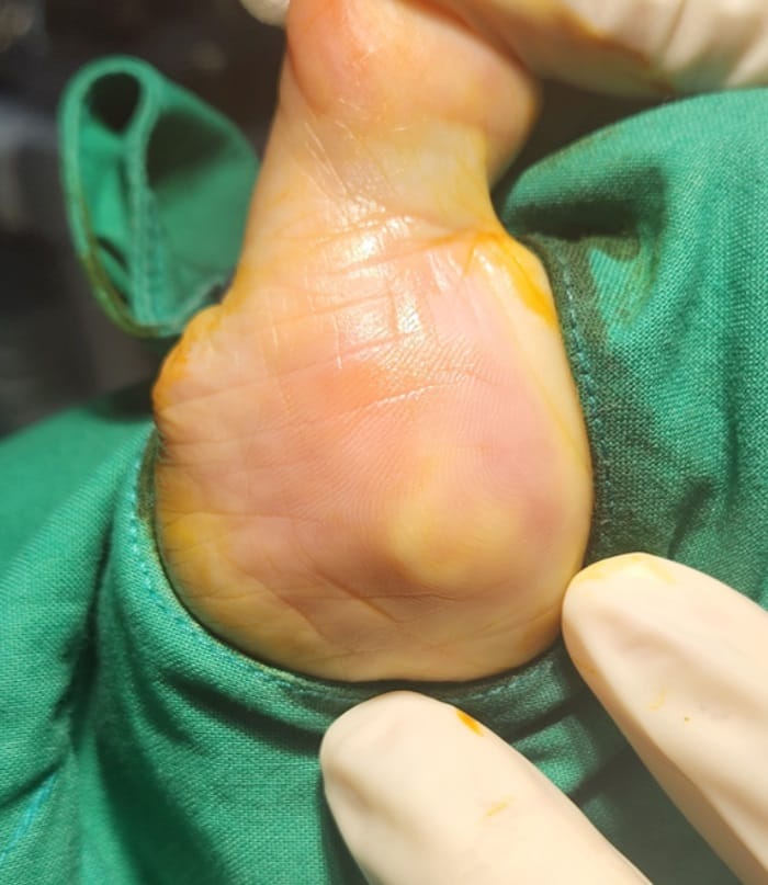 Thought It Was a Corn or Callus — Turned Out to Be a Benign Tumor on the Sole of the Foot — 2