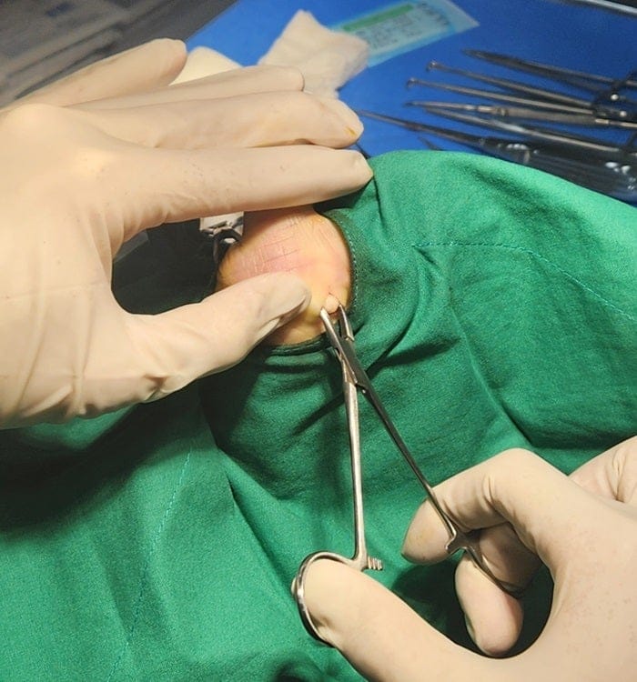 Thought It Was a Corn or Callus — Turned Out to Be a Benign Tumor on the Sole of the Foot — 3