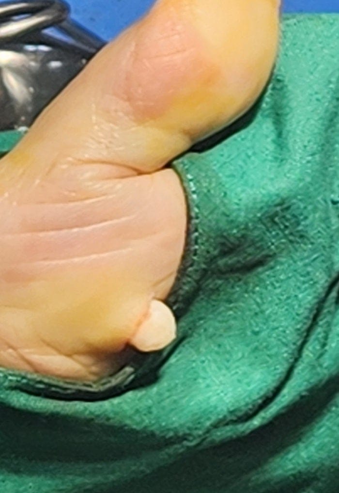 Thought It Was a Corn or Callus — Turned Out to Be a Benign Tumor on the Sole of the Foot — 4