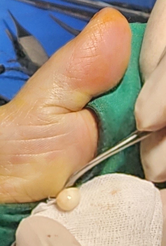 Thought It Was a Corn or Callus — Turned Out to Be a Benign Tumor on the Sole of the Foot — 5