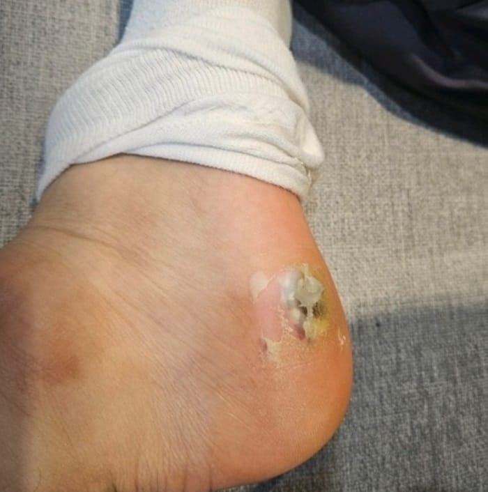 Plantar Corn vs. Wart: What Looked Like a Corn Was Actually a Wart — 4