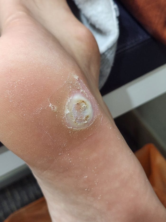 Plantar Corn vs. Wart: What Looked Like a Corn Was Actually a Wart — 6