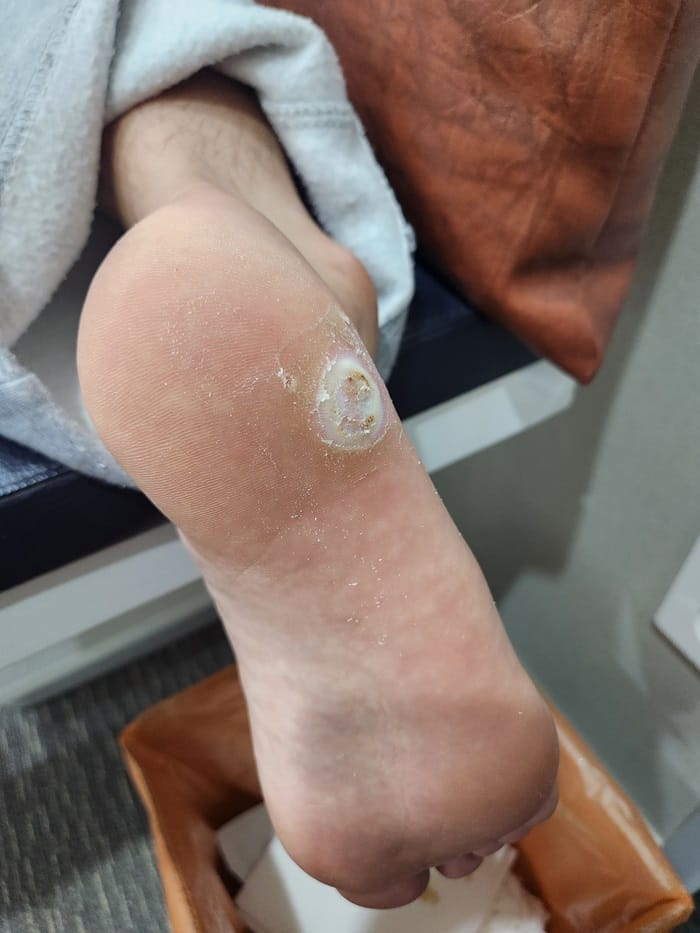 Plantar Corn vs. Wart: What Looked Like a Corn Was Actually a Wart — 7