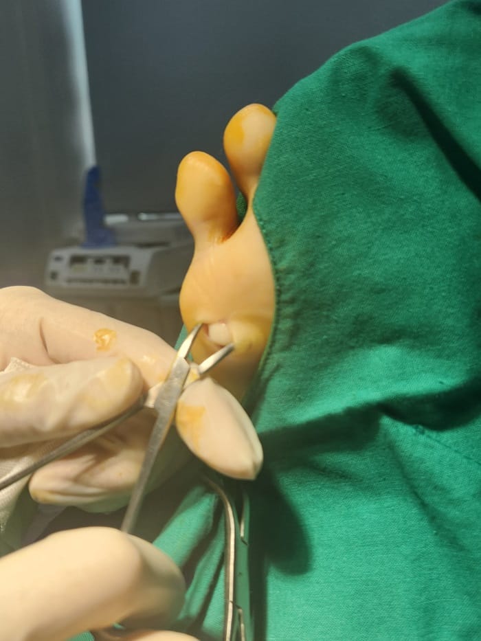No Improvement from Corn Cryotherapy — Turned Out to Be a Plantar Benign Tumor (Epidermal Cyst) — 2