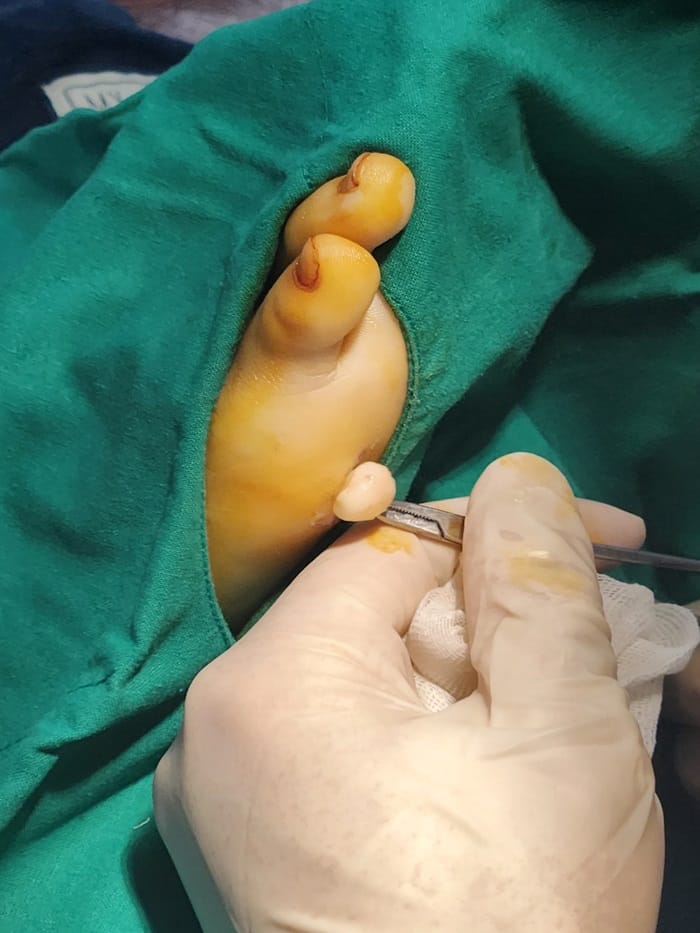 No Improvement from Corn Cryotherapy — Turned Out to Be a Plantar Benign Tumor (Epidermal Cyst) — 3