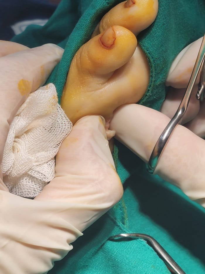 No Improvement from Corn Cryotherapy — Turned Out to Be a Plantar Benign Tumor (Epidermal Cyst) — 4