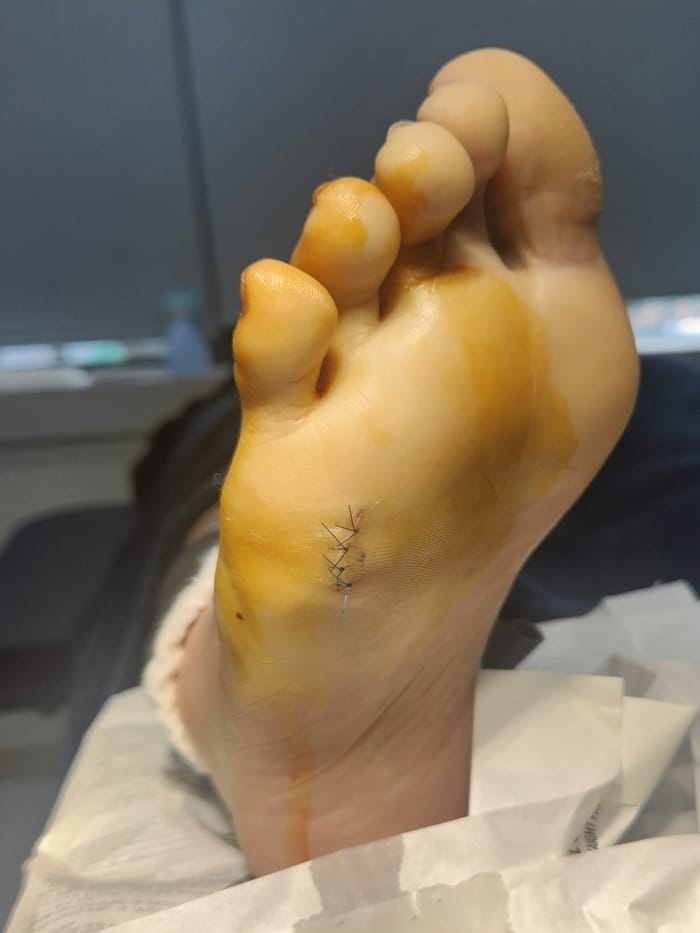 No Improvement from Corn Cryotherapy — Turned Out to Be a Plantar Benign Tumor (Epidermal Cyst) — 5