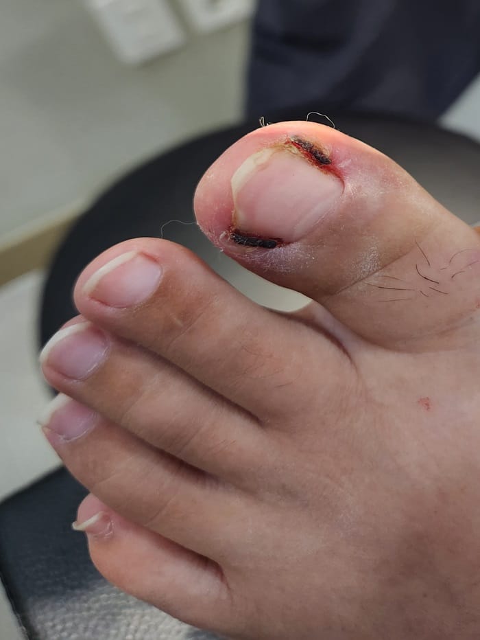 Ingrown Toenail Treatment in Gangnam — Big Toe Pain, Inflammation & Discharge
