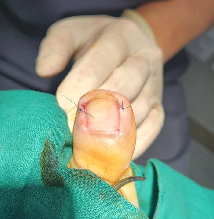 Ingrown Toenail Treatment in Gangnam — Big Toe Pain, Inflammation & Discharge — 2