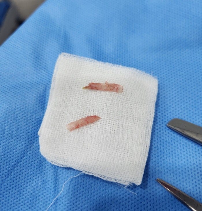 Ingrown Toenail Treatment in Gangnam — Big Toe Pain, Inflammation & Discharge — 3