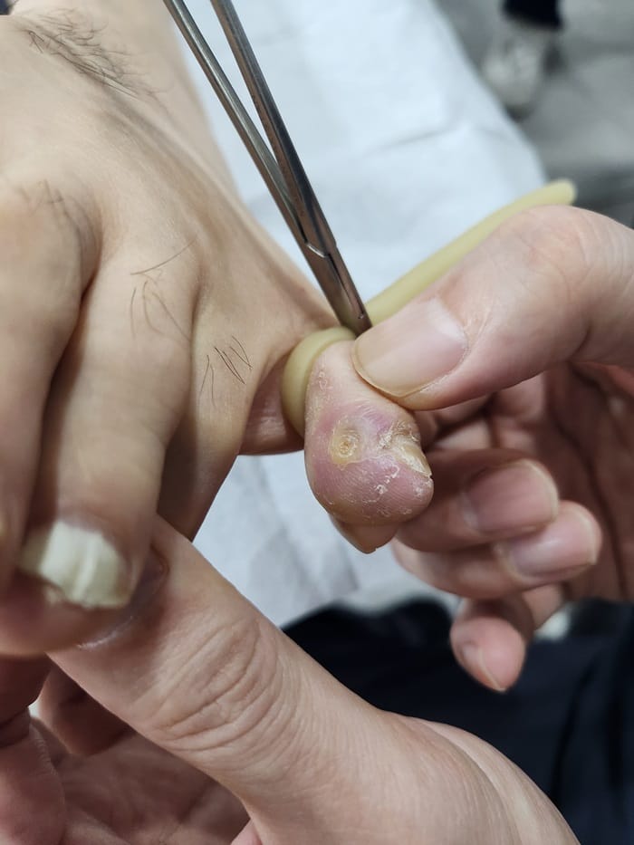 Pinky Toe & Between-Toe Corns and Calluses: Treating the Root Cause at Our Gangnam Orthopedic Clinic — 2