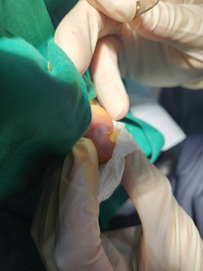 Pinky Toe & Between-Toe Corns and Calluses: Treating the Root Cause at Our Gangnam Orthopedic Clinic — 3