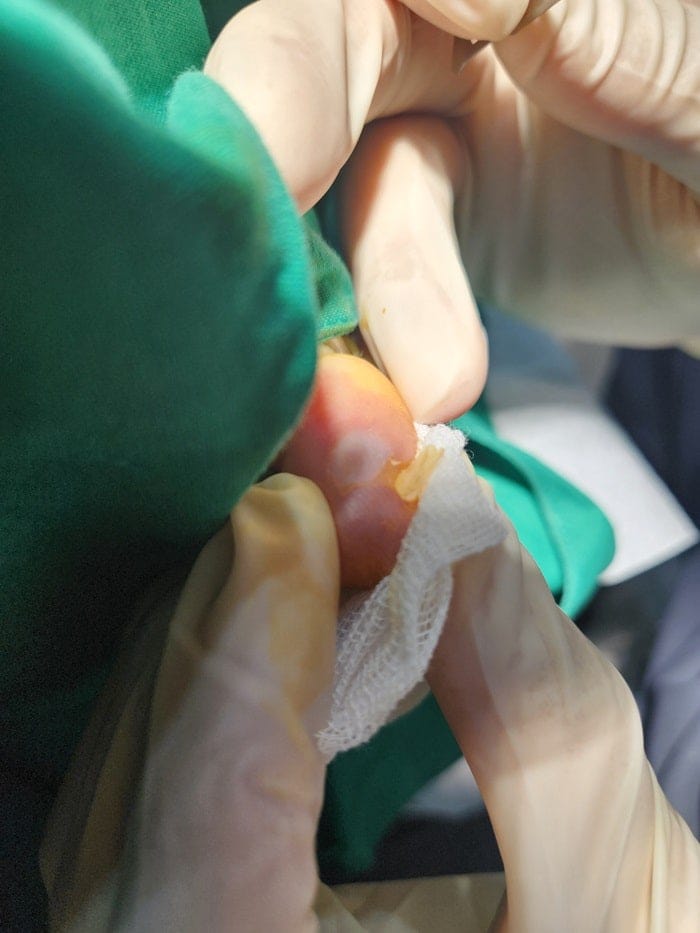 Pinky Toe & Between-Toe Corns and Calluses: Treating the Root Cause at Our Gangnam Orthopedic Clinic — 4