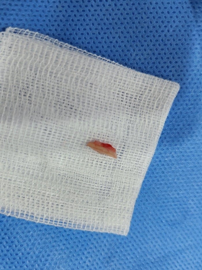 Pinky Toe & Between-Toe Corns and Calluses: Treating the Root Cause at Our Gangnam Orthopedic Clinic — 5