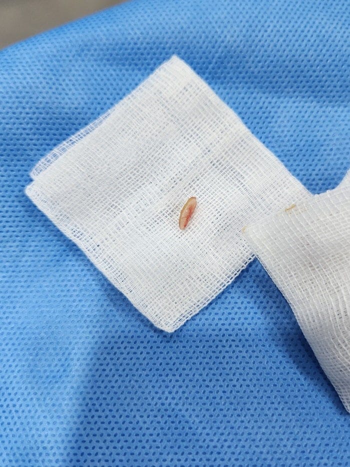 Toe Corns and Calluses on the Little Toe: Treating the Root Cause — 2