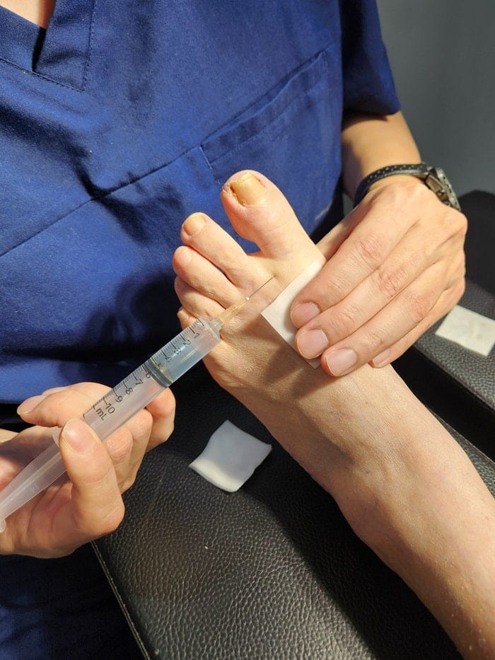 Ingrown Toenail Pain, Inflammation & Discharge — Big Toe Treatment in Gangnam