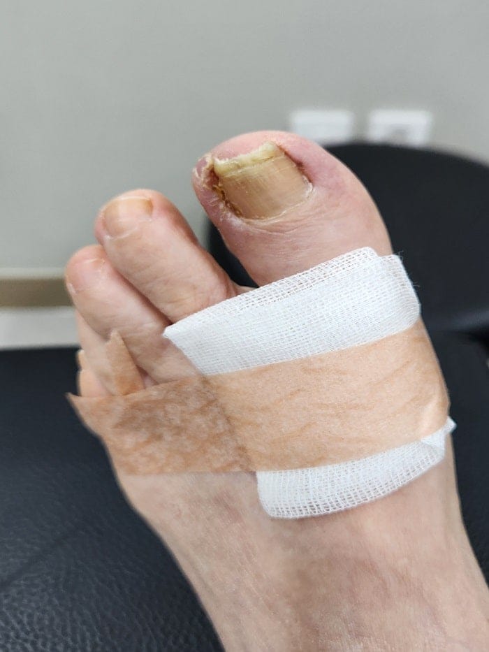 Ingrown Toenail Pain, Inflammation & Discharge — Big Toe Treatment in Gangnam — 2