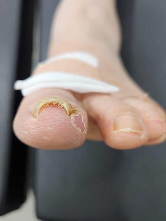 Ingrown Toenail Pain, Inflammation & Discharge — Big Toe Treatment in Gangnam — 3