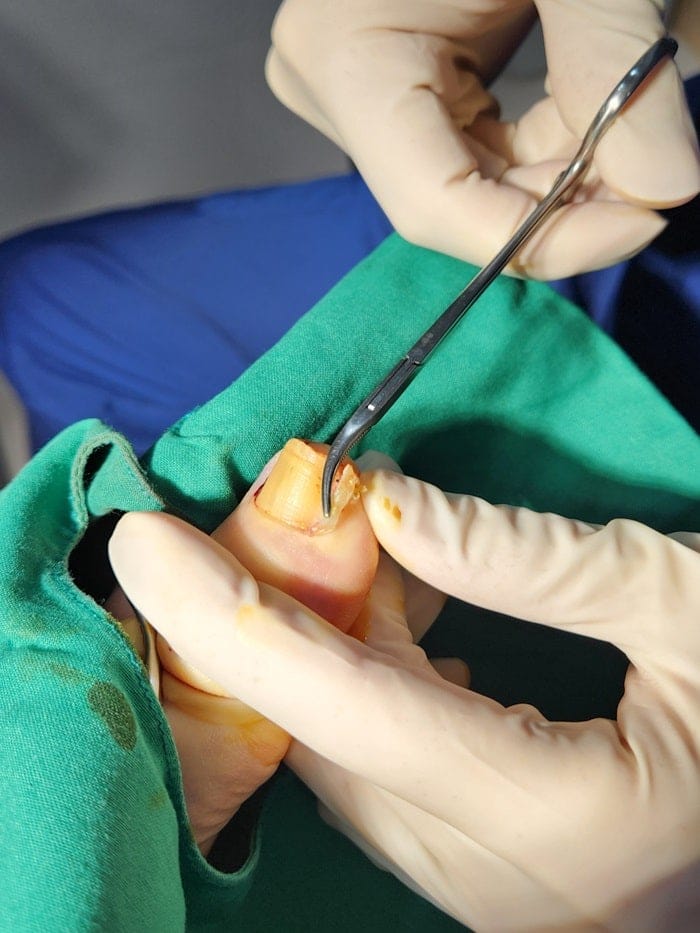 Ingrown Toenail Pain, Inflammation & Discharge — Big Toe Treatment in Gangnam — 4