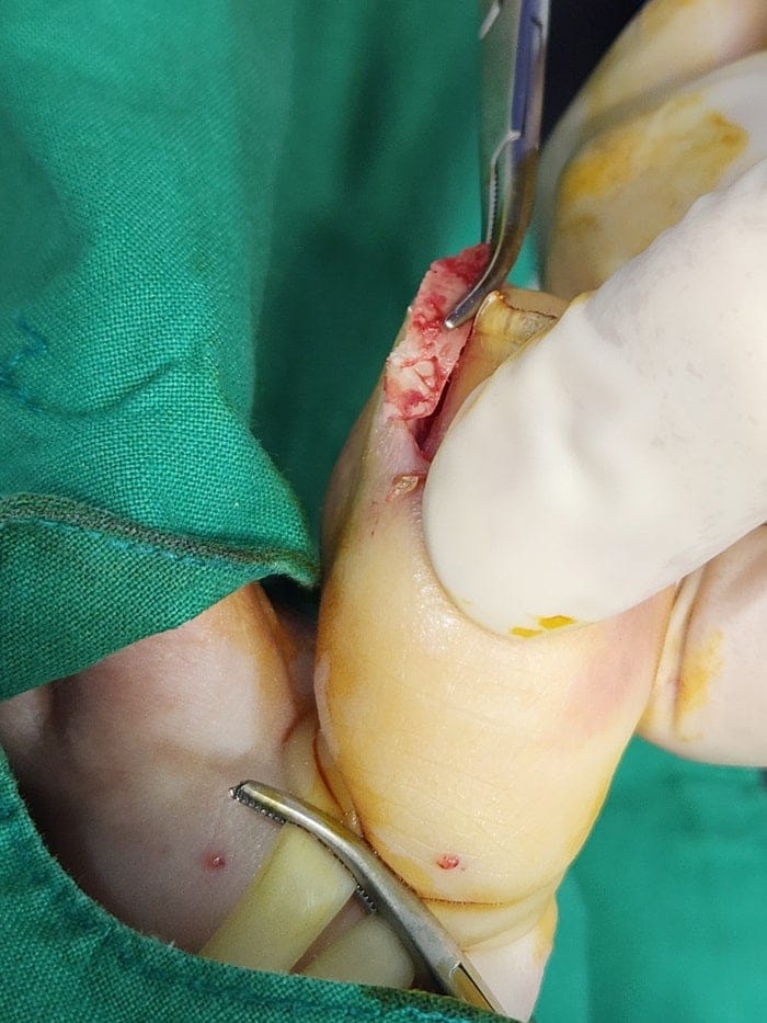 Ingrown Toenail Pain, Inflammation & Discharge — Big Toe Treatment in Gangnam — 5