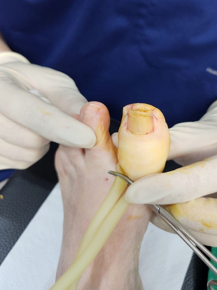 Ingrown Toenail Pain, Inflammation & Discharge — Big Toe Treatment in Gangnam — 6