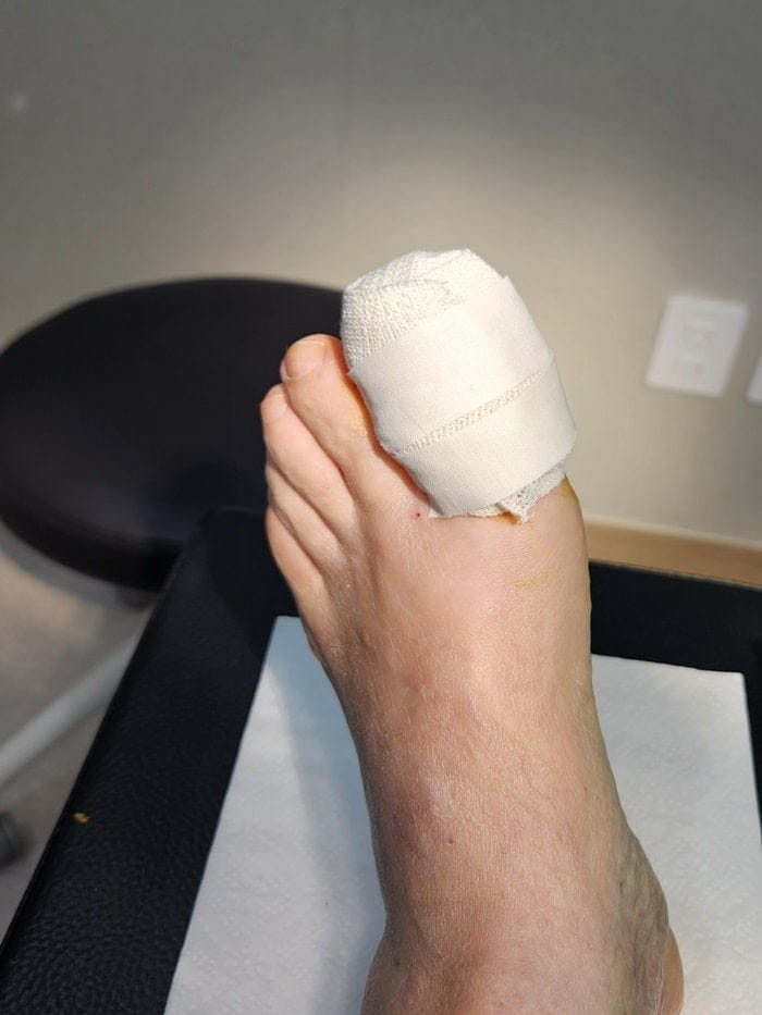 Ingrown Toenail Pain, Inflammation & Discharge — Big Toe Treatment in Gangnam — 7