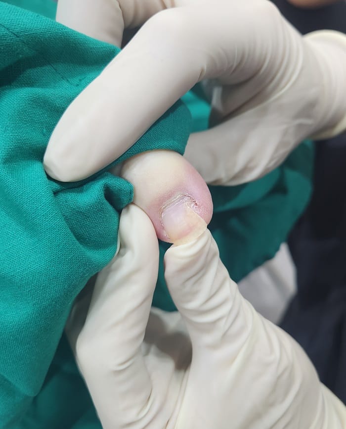 Ingrown Toenail Treatment in Gangnam | Big Toe Pain & Infection — Gangnam Standard Orthopedic Clinic