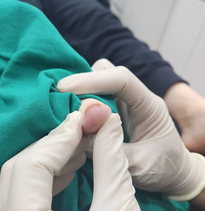 Ingrown Toenail Treatment in Gangnam | Big Toe Pain & Infection — Gangnam Standard Orthopedic Clinic — 2