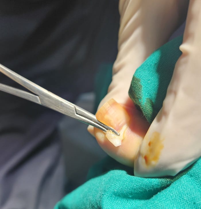 Ingrown Toenail Treatment in Gangnam | Big Toe Pain & Infection — Gangnam Standard Orthopedic Clinic — 3