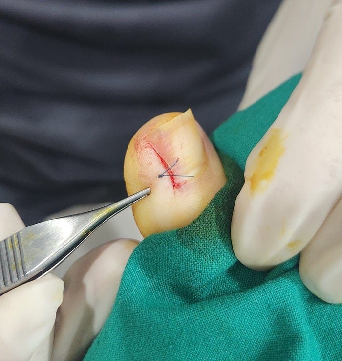 Ingrown Toenail Treatment in Gangnam | Big Toe Pain & Infection — Gangnam Standard Orthopedic Clinic — 4