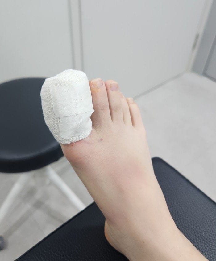 Ingrown Toenail Treatment in Gangnam | Big Toe Pain & Infection — Gangnam Standard Orthopedic Clinic — 5