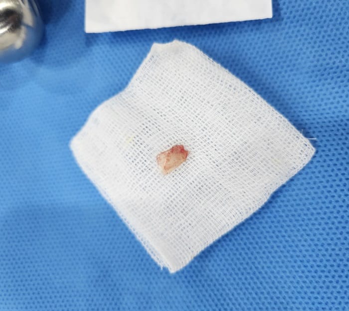 Ingrown Toenail Treatment in Gangnam | Big Toe Pain & Infection — Gangnam Standard Orthopedic Clinic — 6