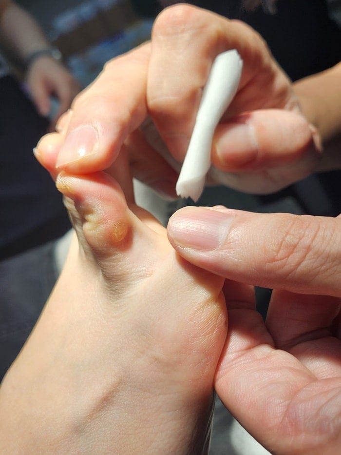 Toe Blisters, Corns & Calluses Treated by a Foot Specialist at Gangnam Standard Orthopedic Clinic