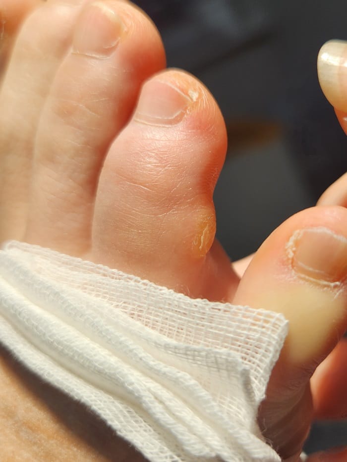 Toe Blisters, Corns & Calluses Treated by a Foot Specialist at Gangnam Standard Orthopedic Clinic — 2