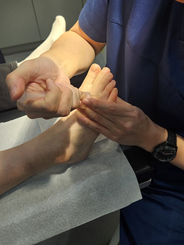 Toe Blisters, Corns & Calluses Treated by a Foot Specialist at Gangnam Standard Orthopedic Clinic — 3