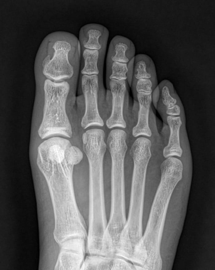 Toe Blisters, Corns & Calluses Treated by a Foot Specialist at Gangnam Standard Orthopedic Clinic — 4